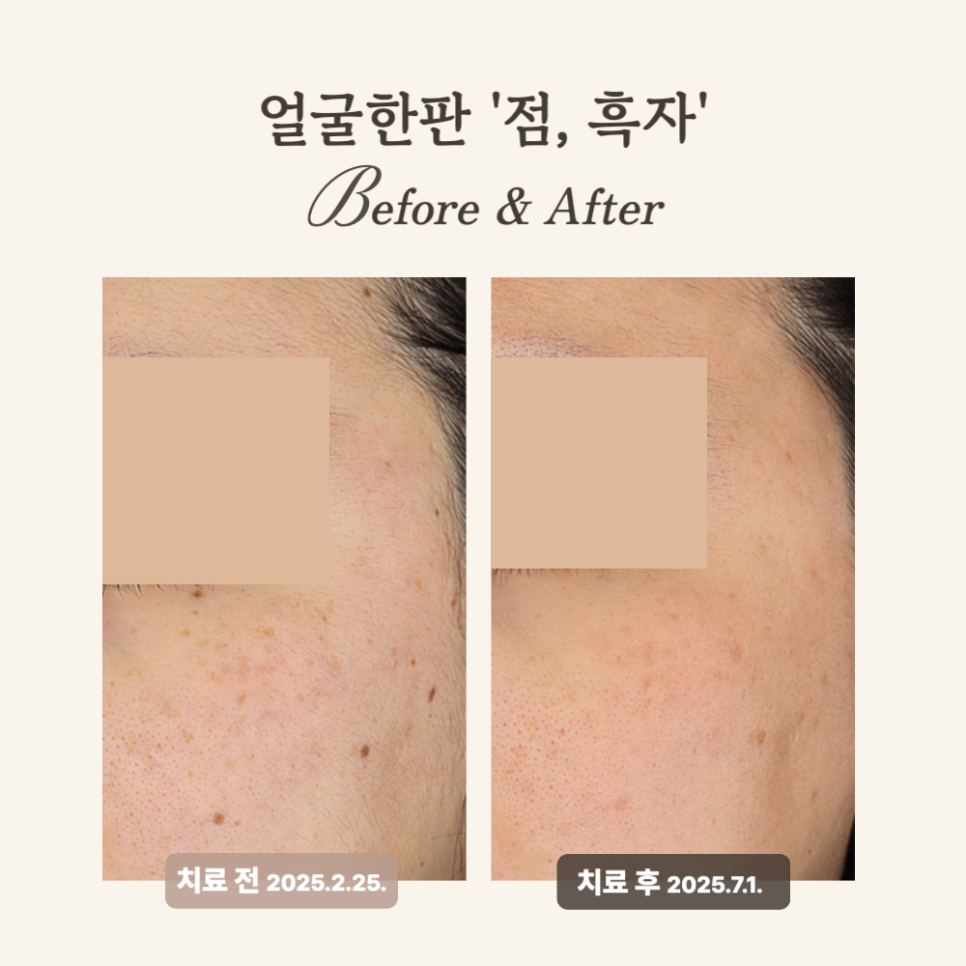 20대 얼굴한판 시술 후기: 점·흑자 제거 효과