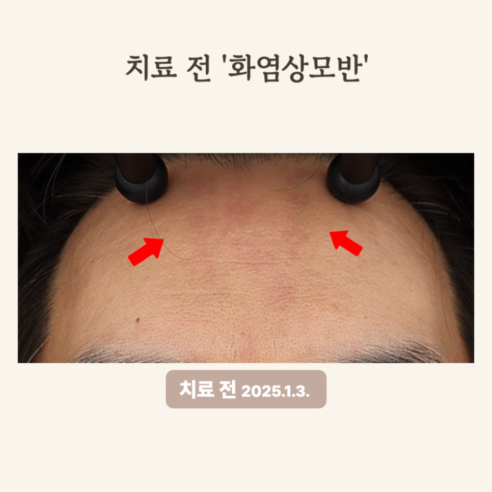 30대 이마 화염상모반, 3회 브이빔 후기