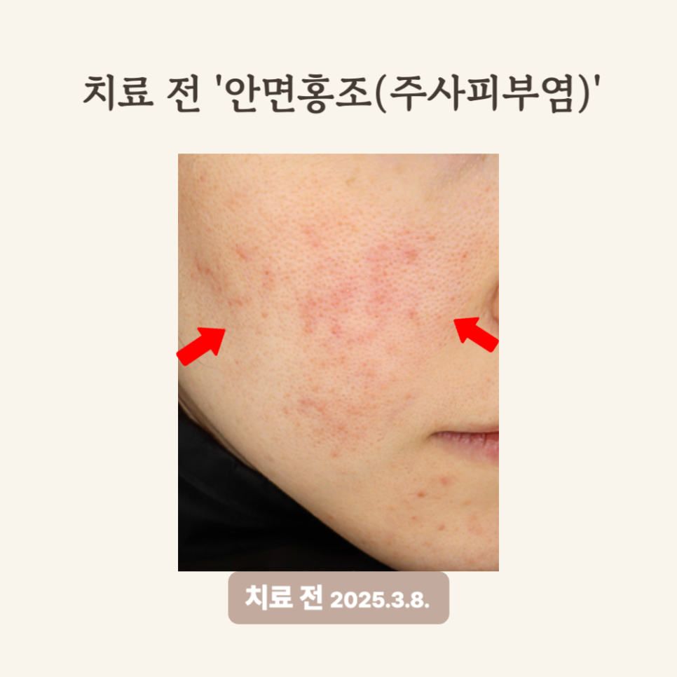 30대 주사피부염, 브이빔+PRP 2회 치료 후 홍조 개선 후기