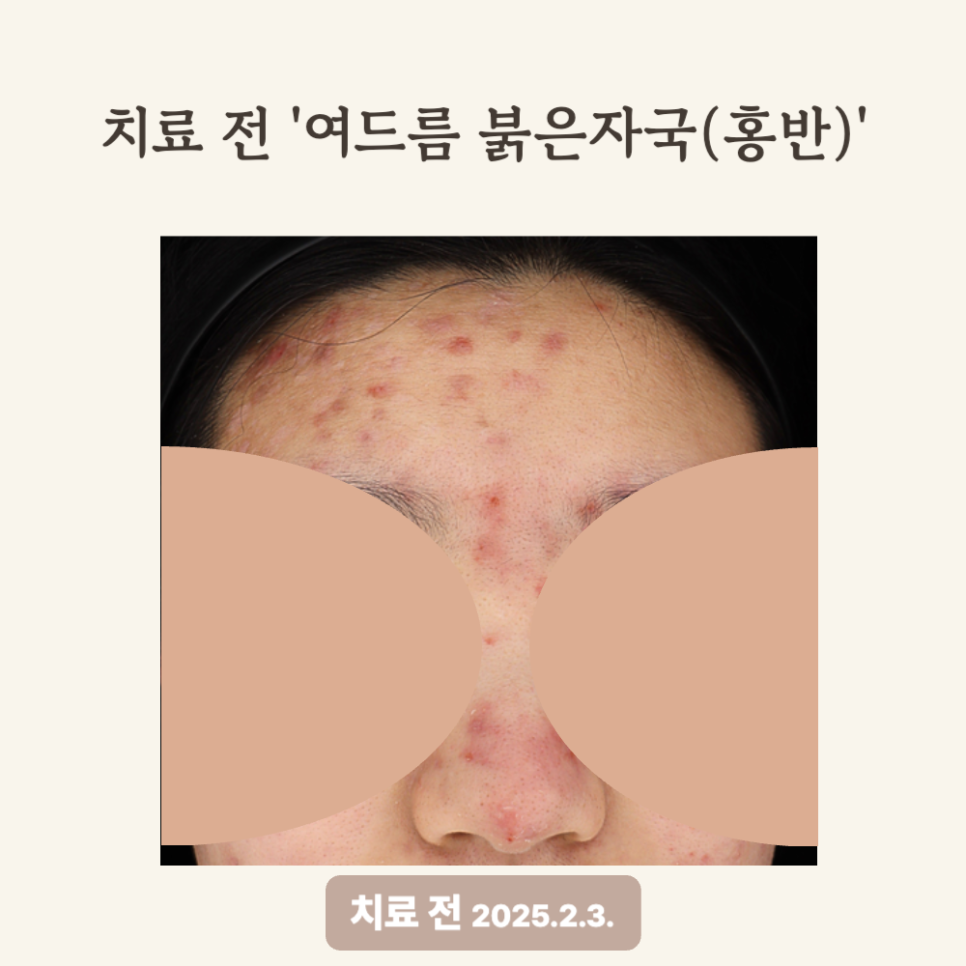 20대 이마·코 홍반, 브이빔 레이저 4회 치료 후기