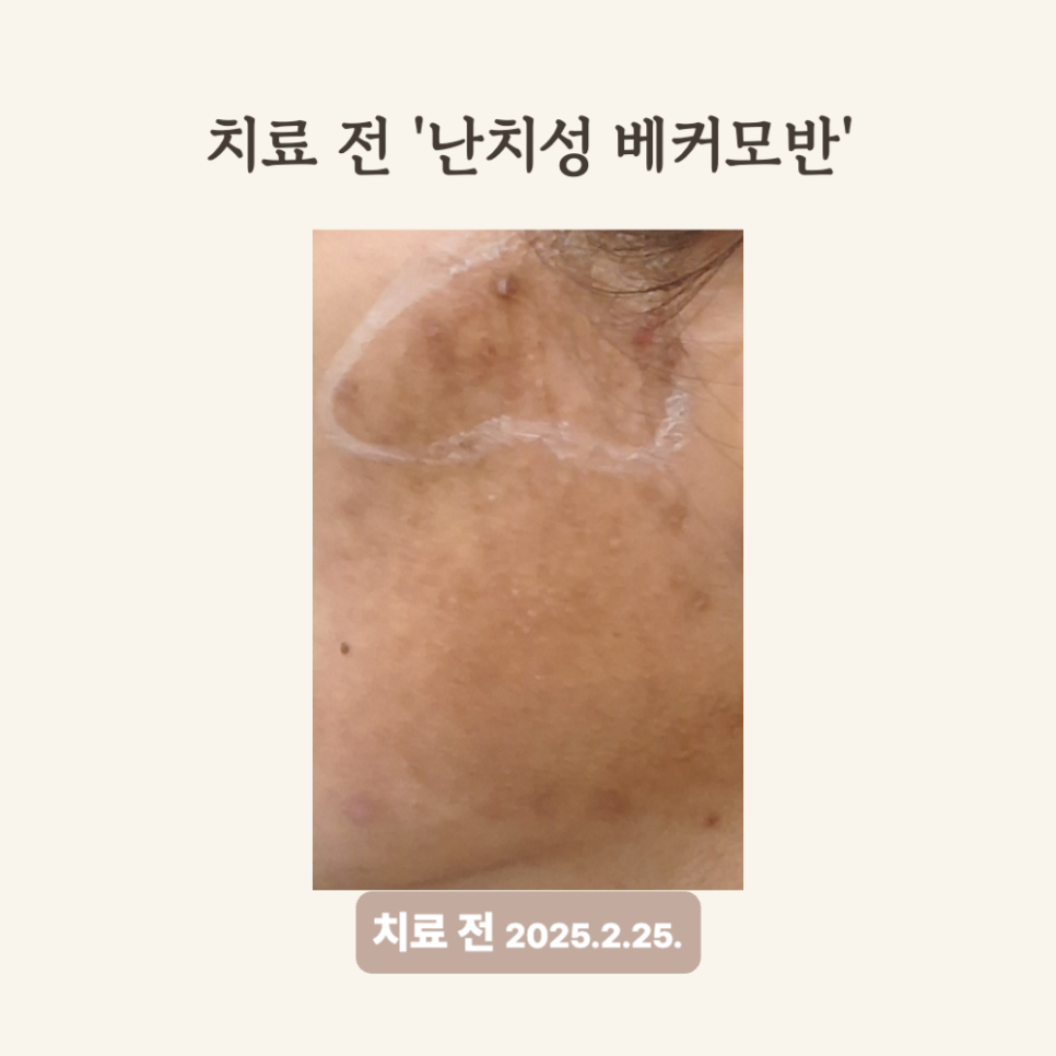 30대 베커모반 레이저토닝 치료 후기