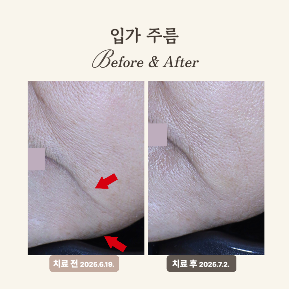 60대 레디어스 시술 후기: 입가 주름 개선과 탄력 회복의 비결