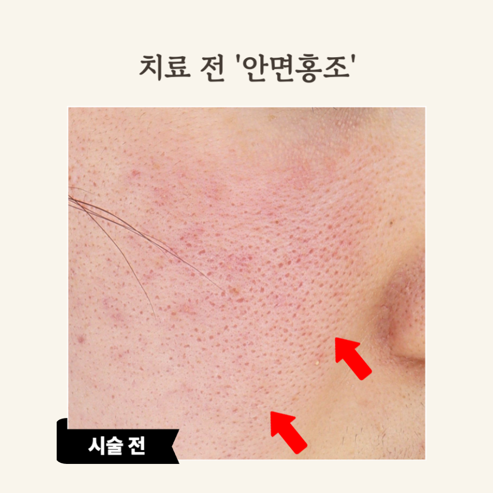 브이빔 레이저 30대 안면홍조 시술 후기: 효과적인 치료!