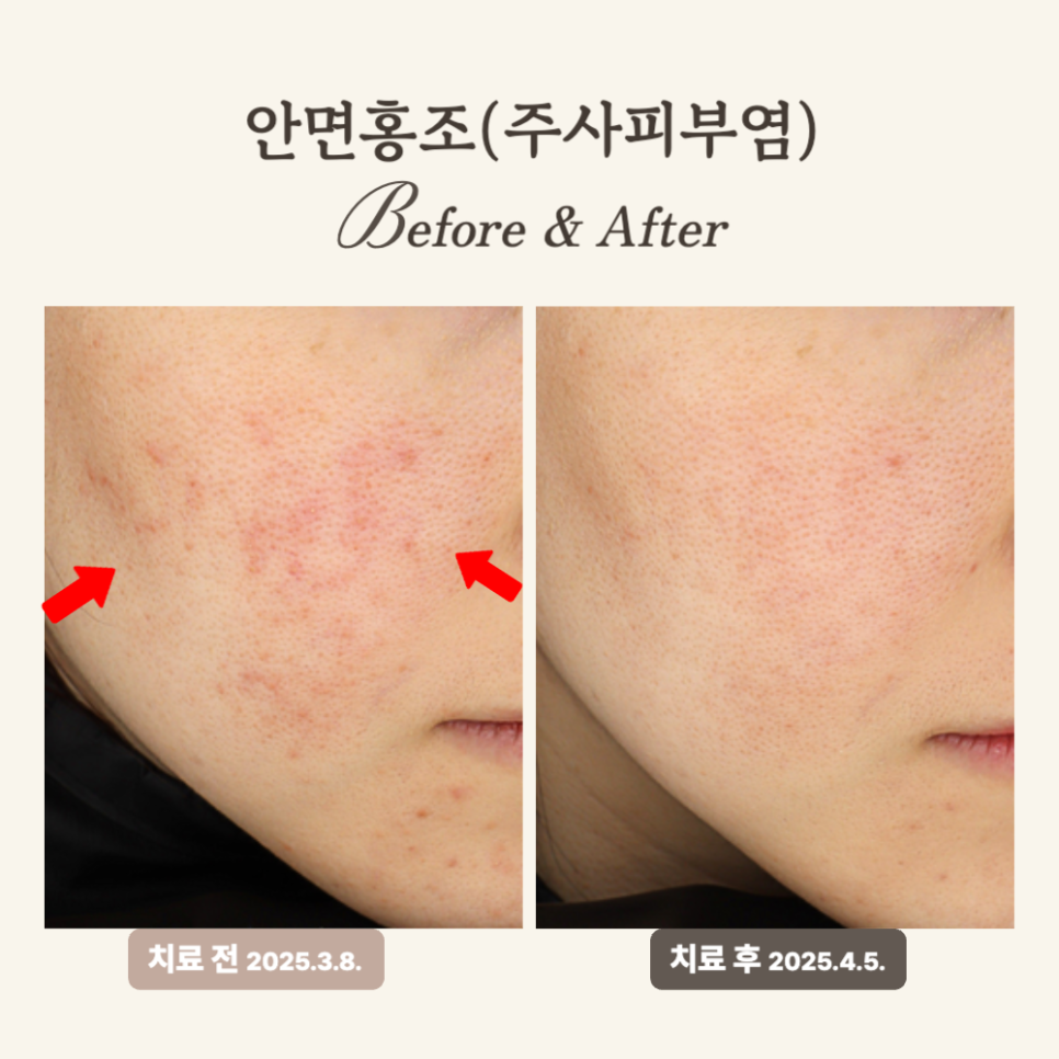 30대 주사피부염, 브이빔+PRP 2회 치료 후 홍조 개선 후기