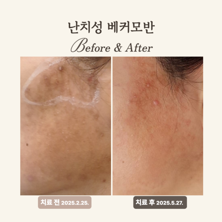 30대 베커모반 레이저토닝 치료 후기