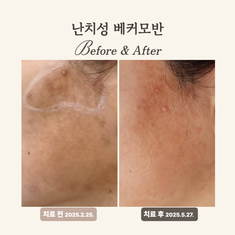 30대 베커모반 레이저토닝 치료 후기