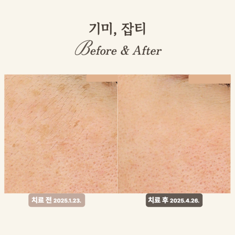 30대 눈 아래 잡티 개선, 피코토닝 듀얼토닝 후기로 확인하세요