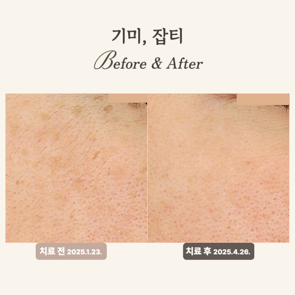 30대 눈 아래 잡티 개선, 피코토닝 듀얼토닝 후기로 확인하세요