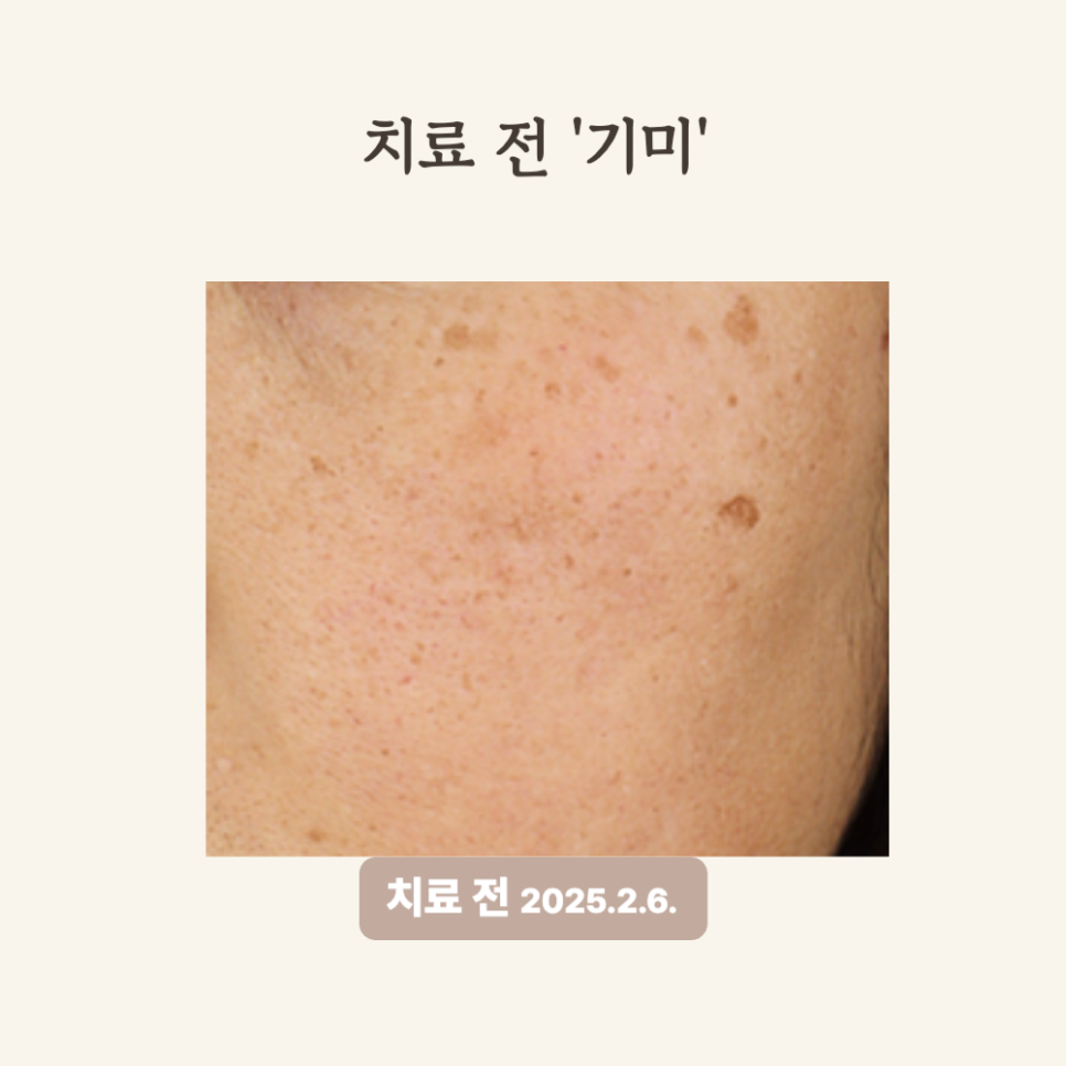 40대 진피형 기미, 레이저토닝 시술 후기와 변화