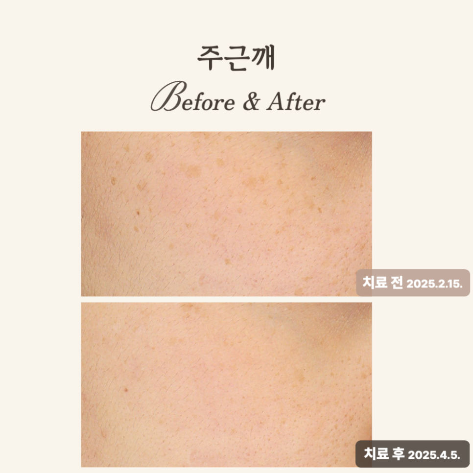 20대, 주근깨와 균일한 피부톤 위한 얼굴한판 치료 후기
