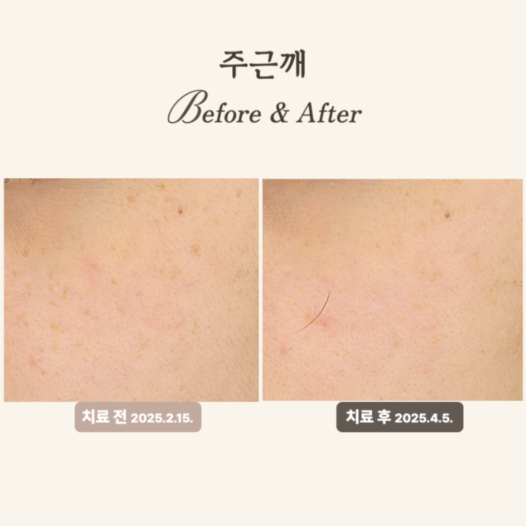 20대, 주근깨와 균일한 피부톤 위한 얼굴한판 치료 후기