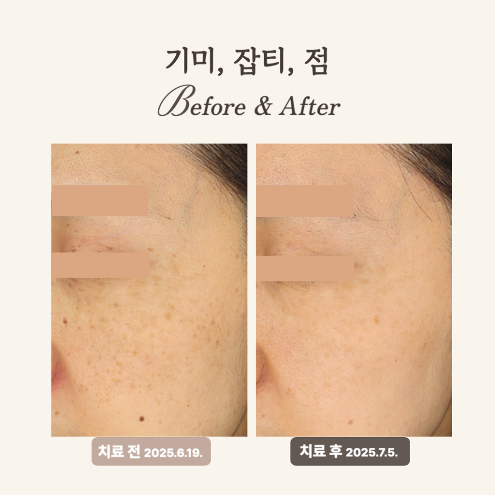 30대 혼합형 기미 레이저토닝 치료 후기