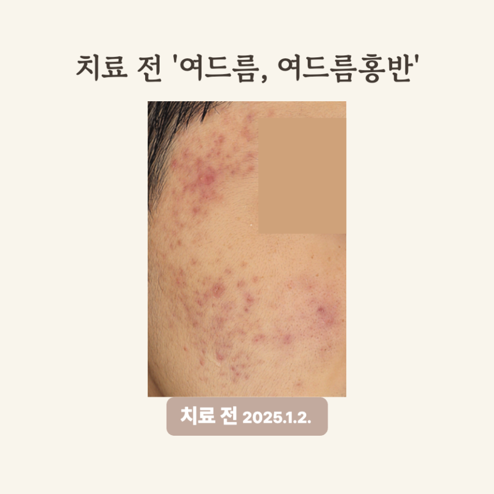 10대 여드름 고민? 브이빔레이저 치료 후기