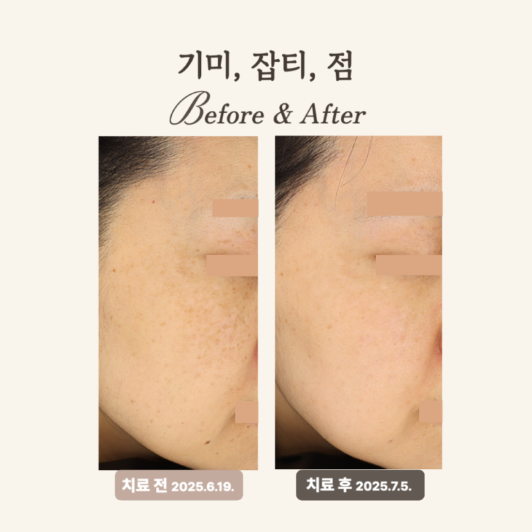 30대 혼합형 기미 레이저토닝 치료 후기
