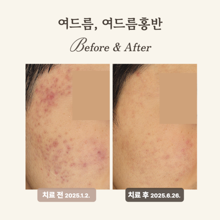 10대 여드름 고민? 브이빔레이저 치료 후기