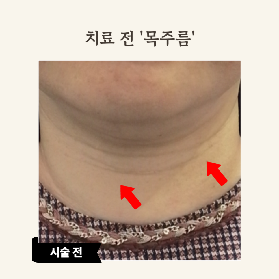 60대, 깊은 목주름 필러 시술 후기: 레디어스로 탄력 회복