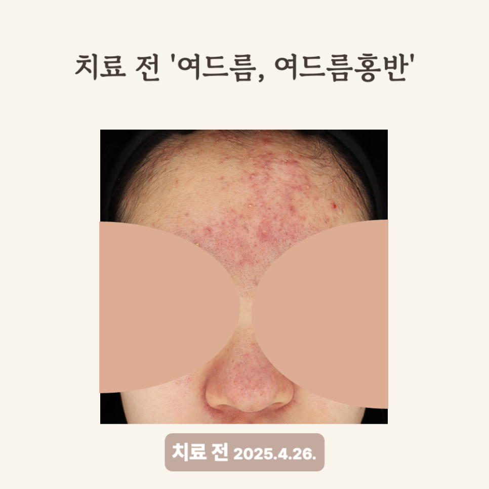 10대 여드름 치료 후기: 골드PTT와 브이빔 횟수별 효과는?