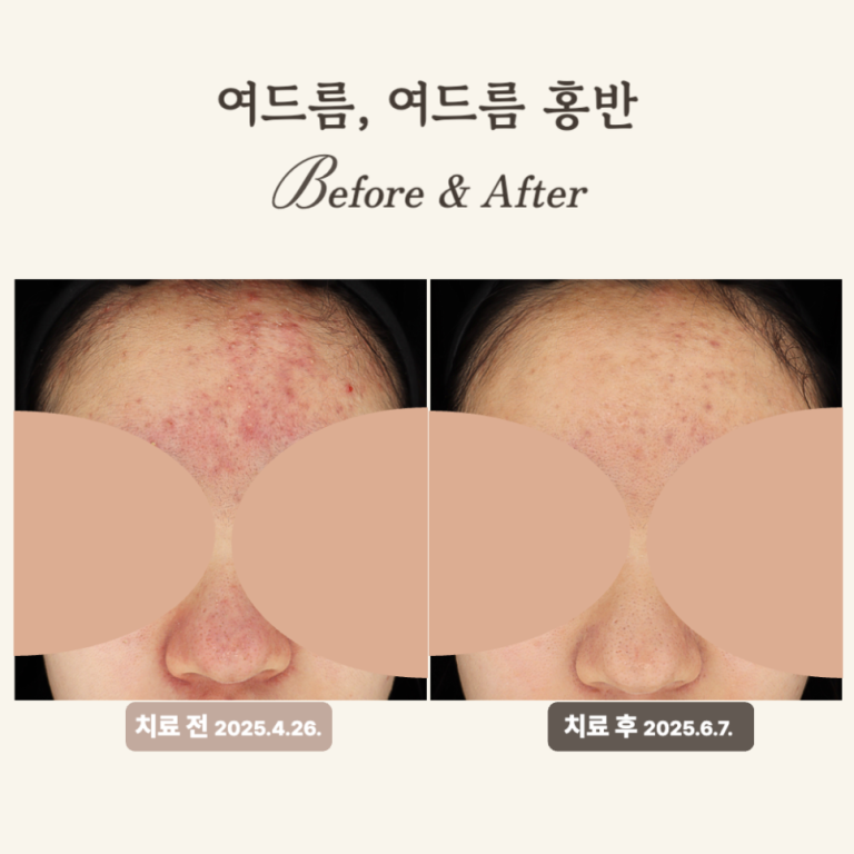 10대 여드름 치료 후기: 골드PTT와 브이빔 횟수별 효과는?