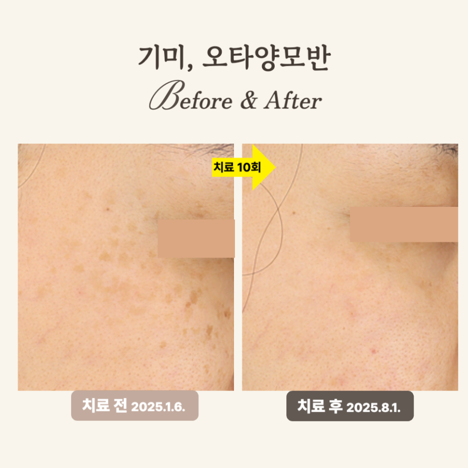 40대 레이저토닝 시술 후기: 칙칙함 개선과 오타양모반 제거