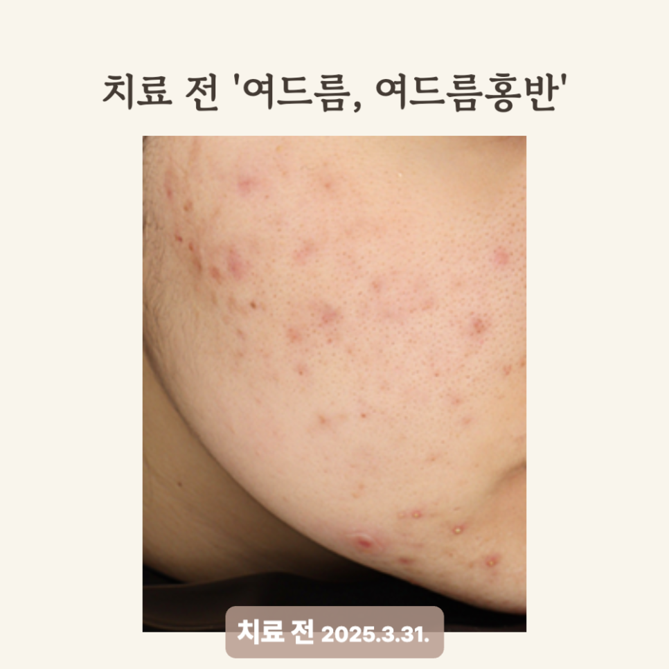 20대 여드름 압출 후 골드PTT와 브이빔레이저 치료 후기