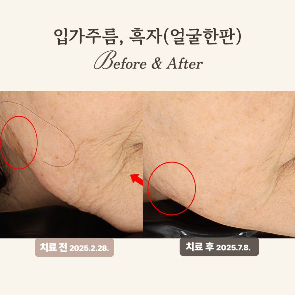 60대 깊은 주름과 탄력 개선, 얼굴한판 시술 후기