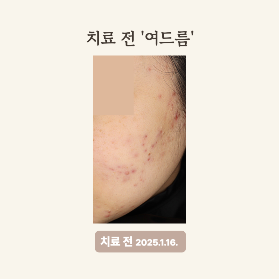20대 골드PTT와 브이빔 시술 후기: 여드름과 홍반 개선