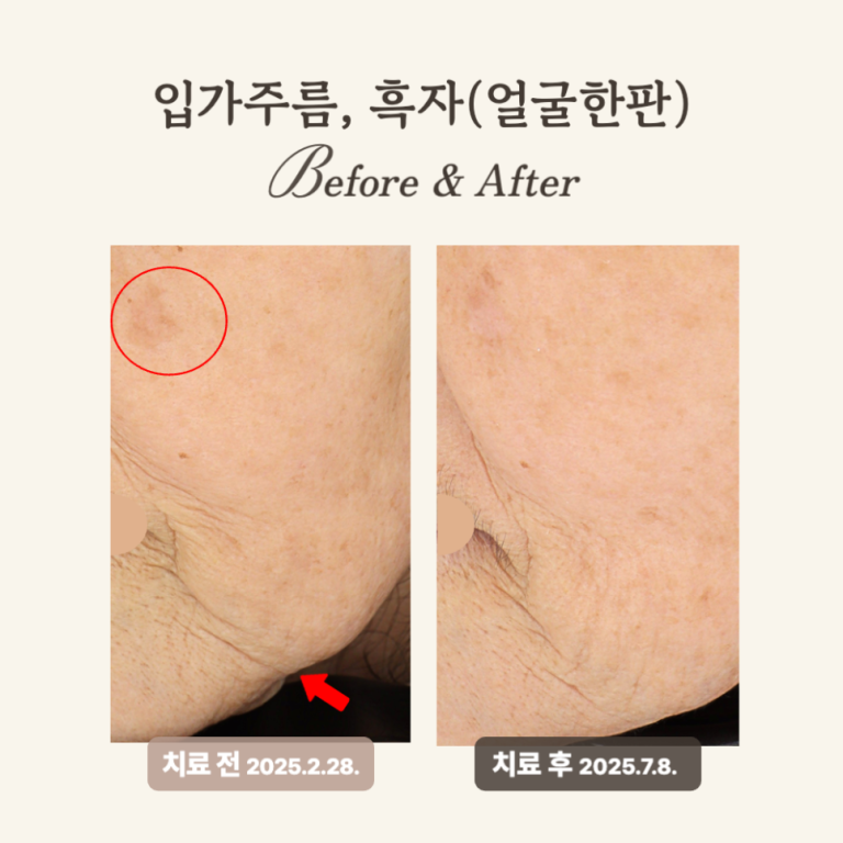 60대 깊은 주름과 탄력 개선, 얼굴한판 시술 후기