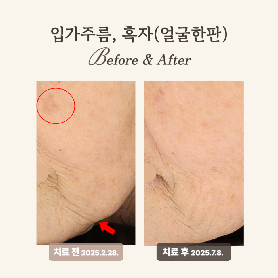 60대 깊은 주름과 탄력 개선, 얼굴한판 시술 후기