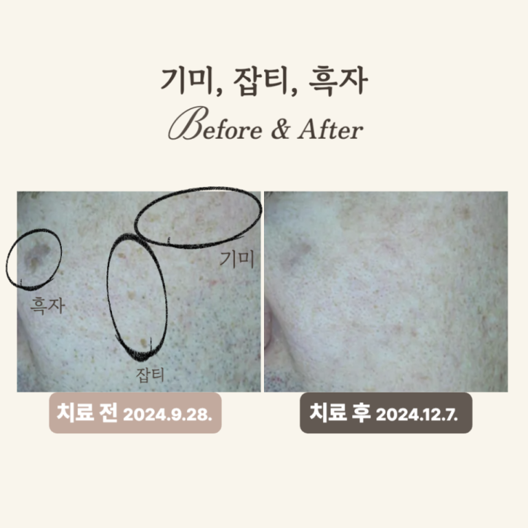 50대 잡티와 기미, 피코토닝 시술 후기
