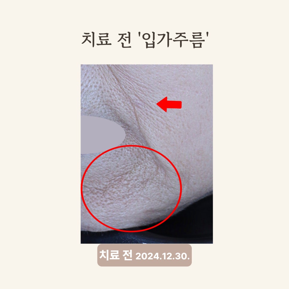 60대 써마지와 레디어스 시술 후기: 주름 개선 및 탄력 회복