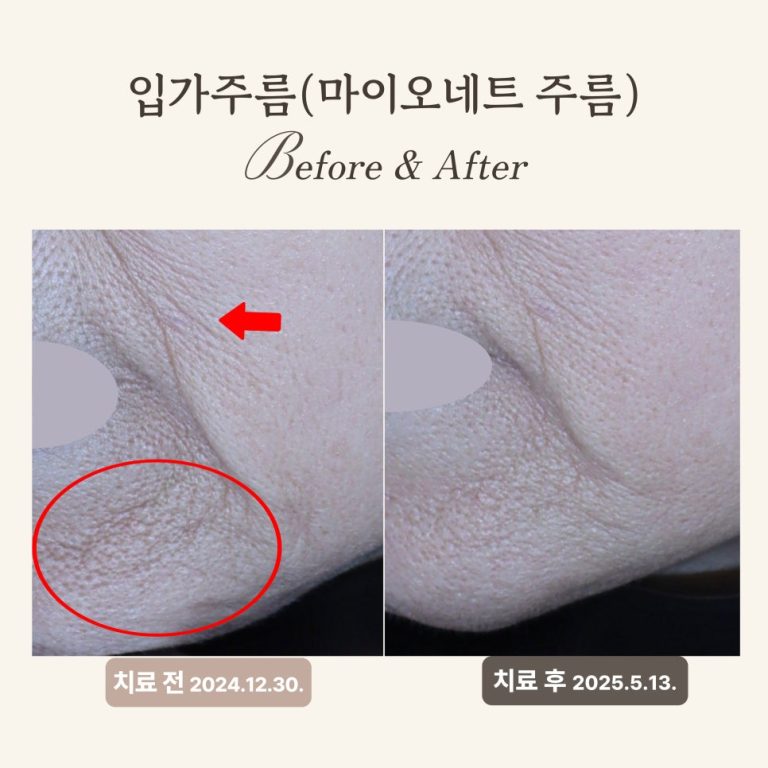 60대 써마지와 레디어스 시술 후기: 주름 개선 및 탄력 회복
