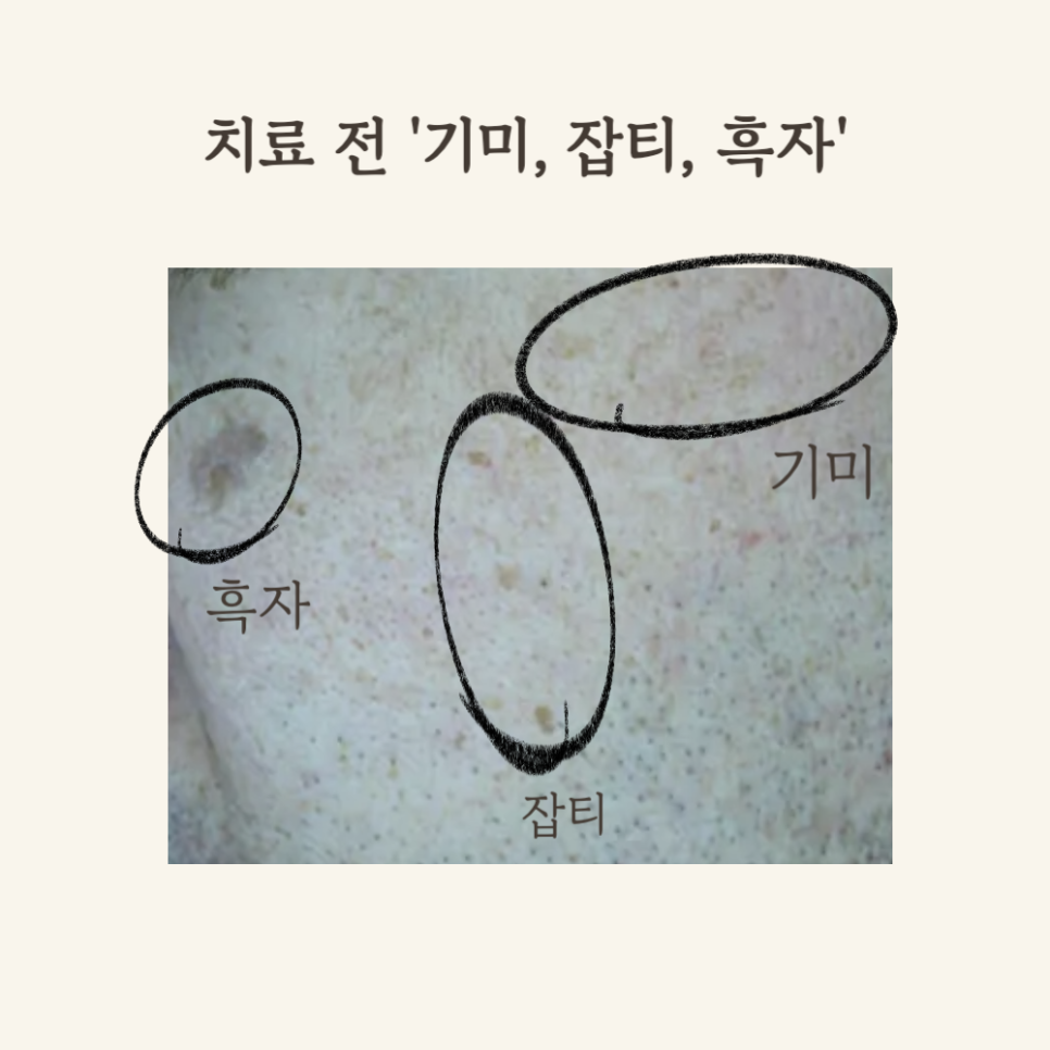 50대 잡티와 기미, 피코토닝 시술 후기