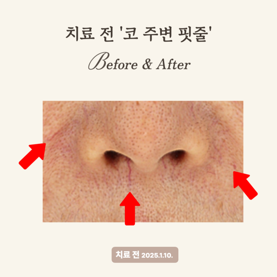 50대, 브이빔 레이저로 홍반과 핏줄 개선 시술 후기