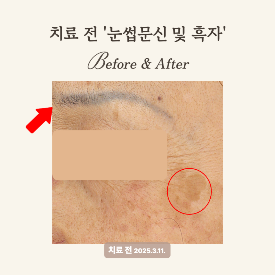 60대 눈썹 문신 제거 후기(레이저 문신제거)