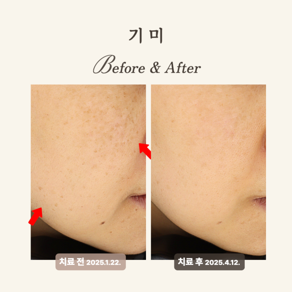 30대 레이저토닝 후기: 기미 개선과 피부톤 균형 회복