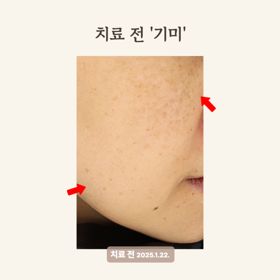 30대 레이저토닝 후기: 기미 개선과 피부톤 균형 회복