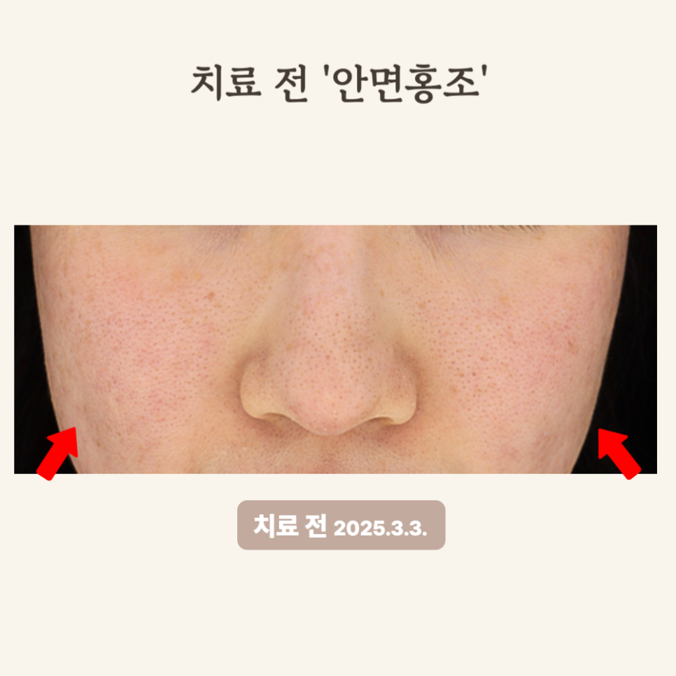 20대 민감성 피부, 브이빔 레이저 1회 시술 후기