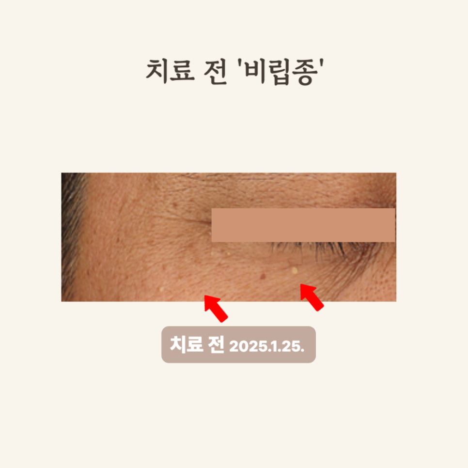 50대 얼굴한판 시술 후기: 비립종, 흑자 개선