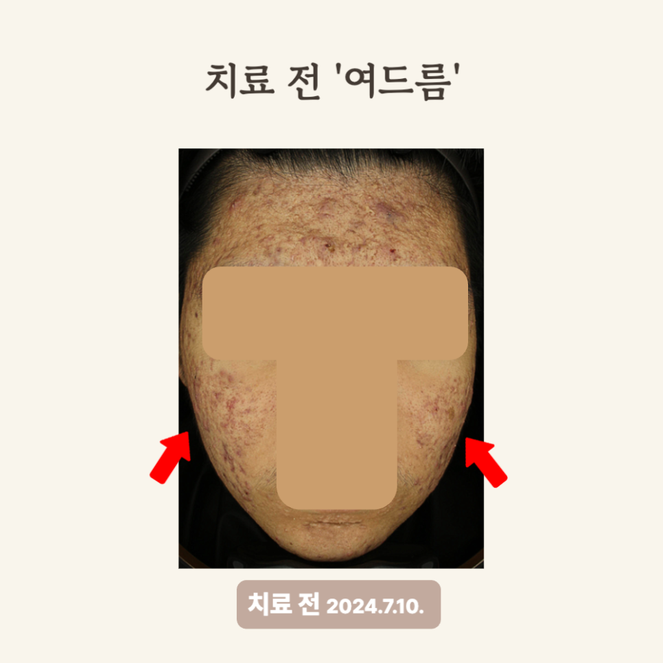 10대 여드름 골드PTT 시술 후 변화 후기