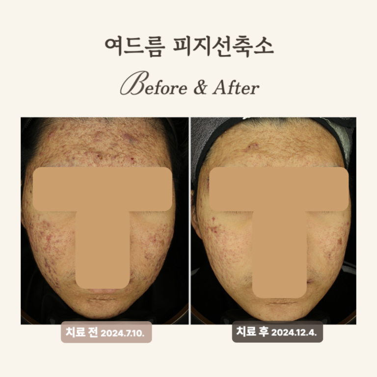 10대 여드름 골드PTT 시술 후 변화 후기