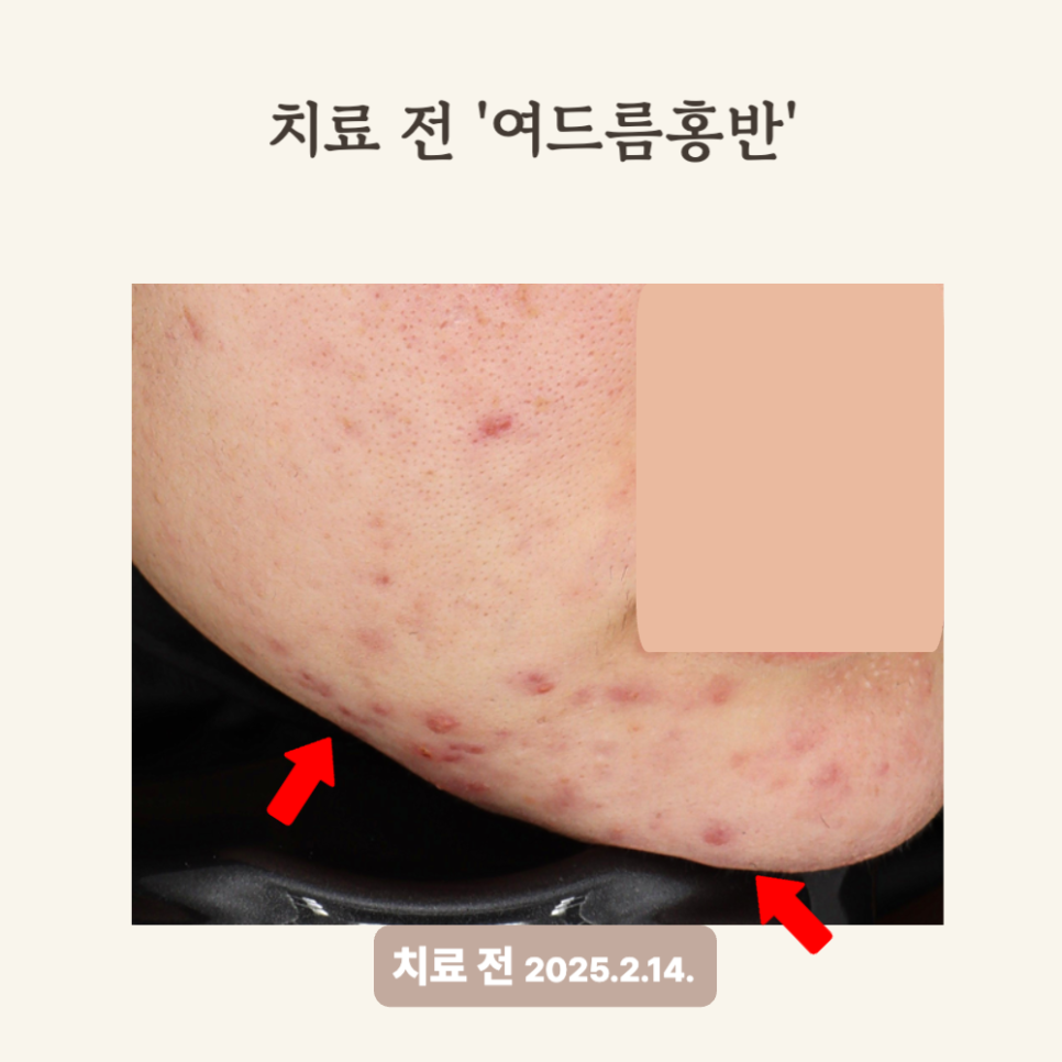 20대 홍반 개선, 브이빔 레이저 치료 후기