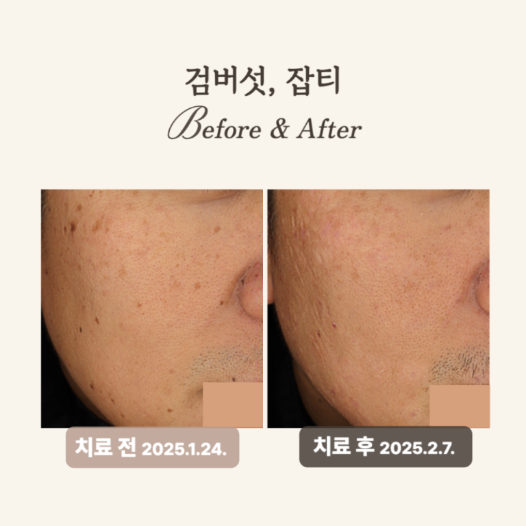 40대 얼굴한판 시술 후기: 잡티 제거와 피부톤 개선