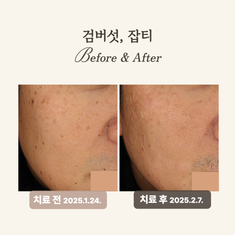 40대 얼굴한판 시술 후기: 잡티 제거와 피부톤 개선