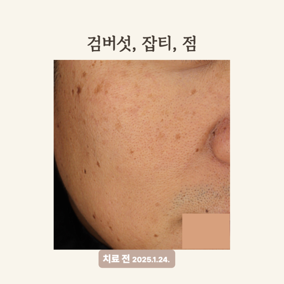 40대 얼굴한판 시술 후기: 잡티 제거와 피부톤 개선