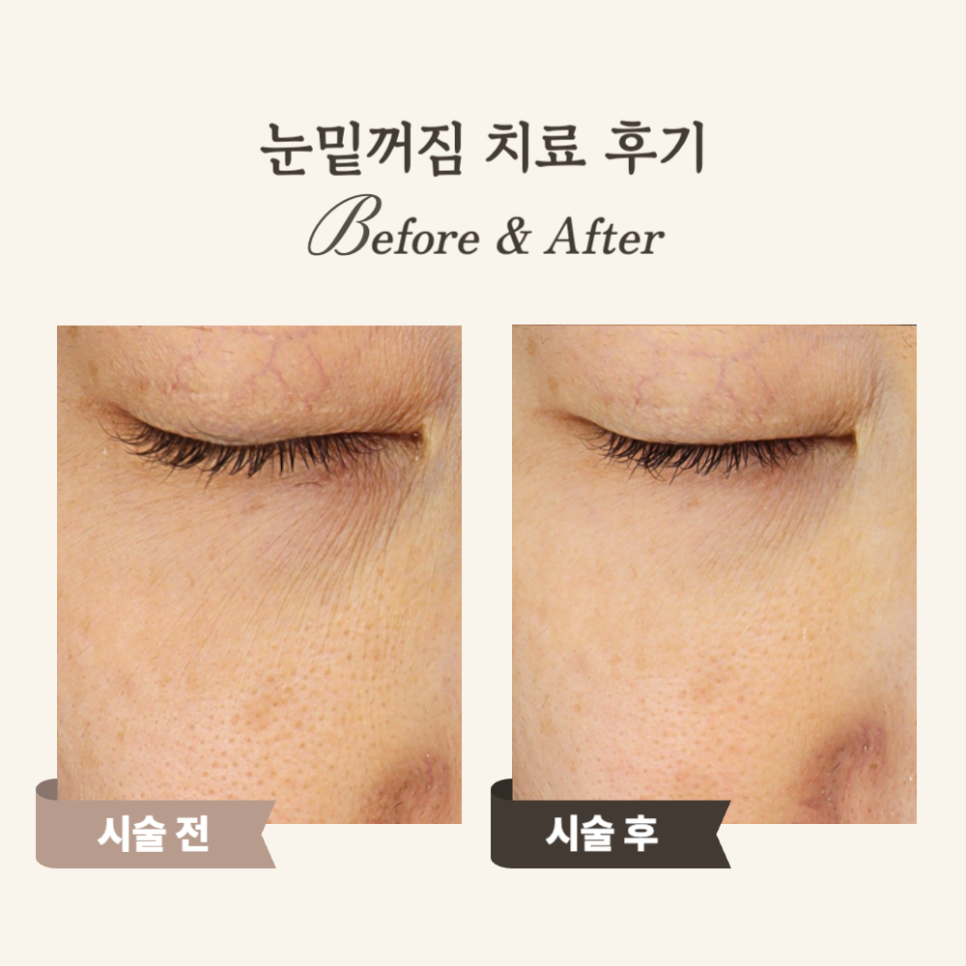 40대 울트라콜·쥬베룩 후 젊어진 얼굴 후기