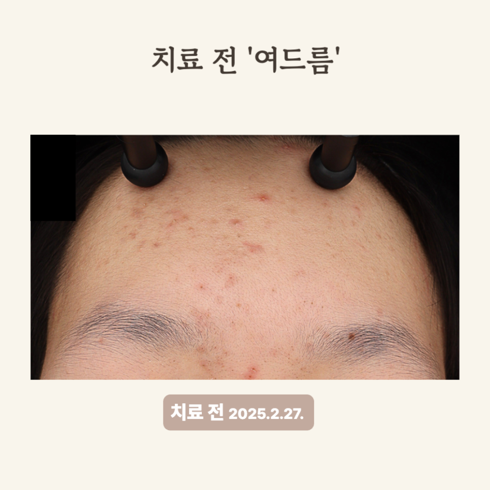 20대 여드름 압출 후 골드PTT로 매끄러워짐