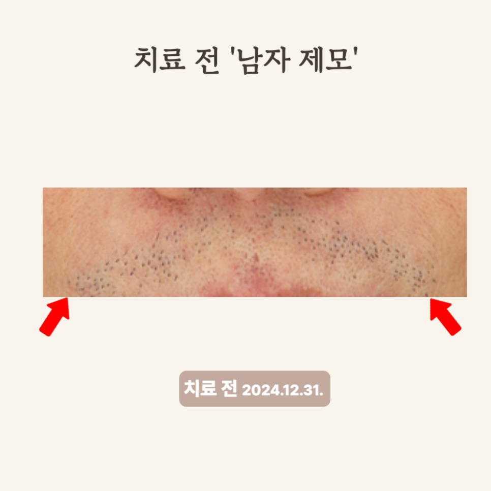 30대 굵은 수염, 제모레이저 치료 후기와 변화