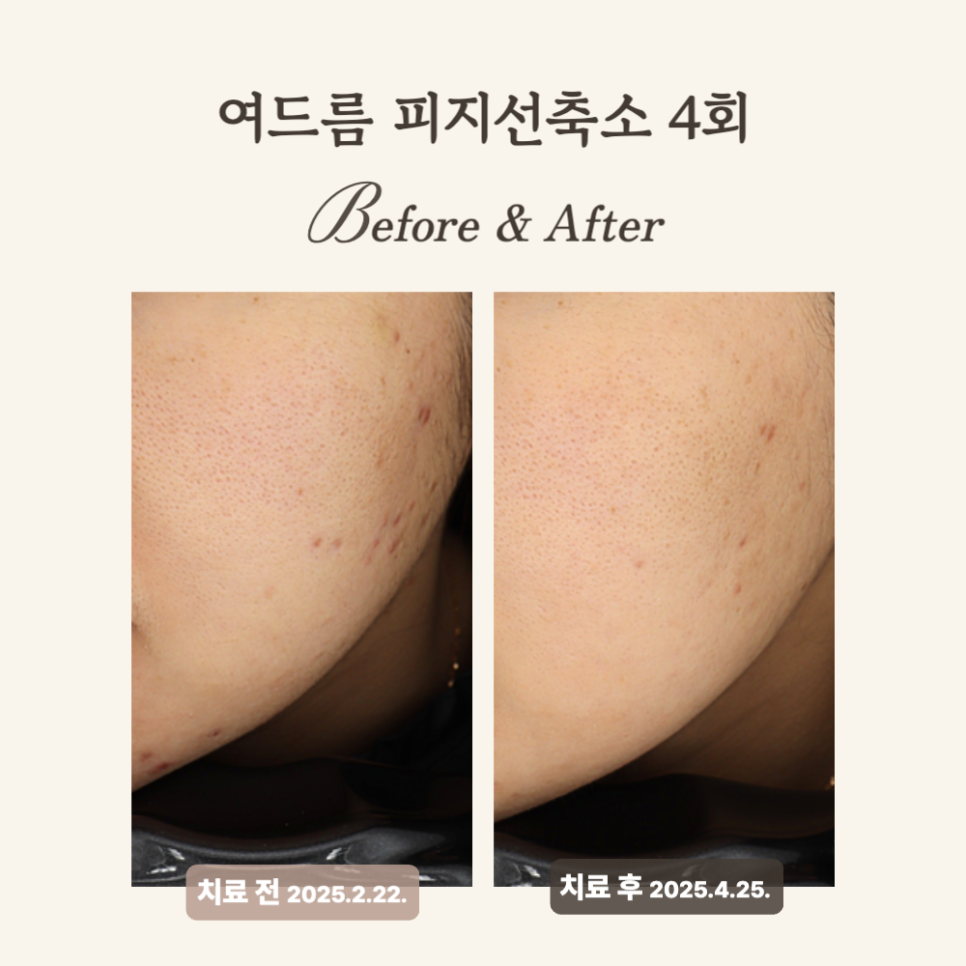 20대 염증성 여드름, 골드PTT+압출 치료 후기