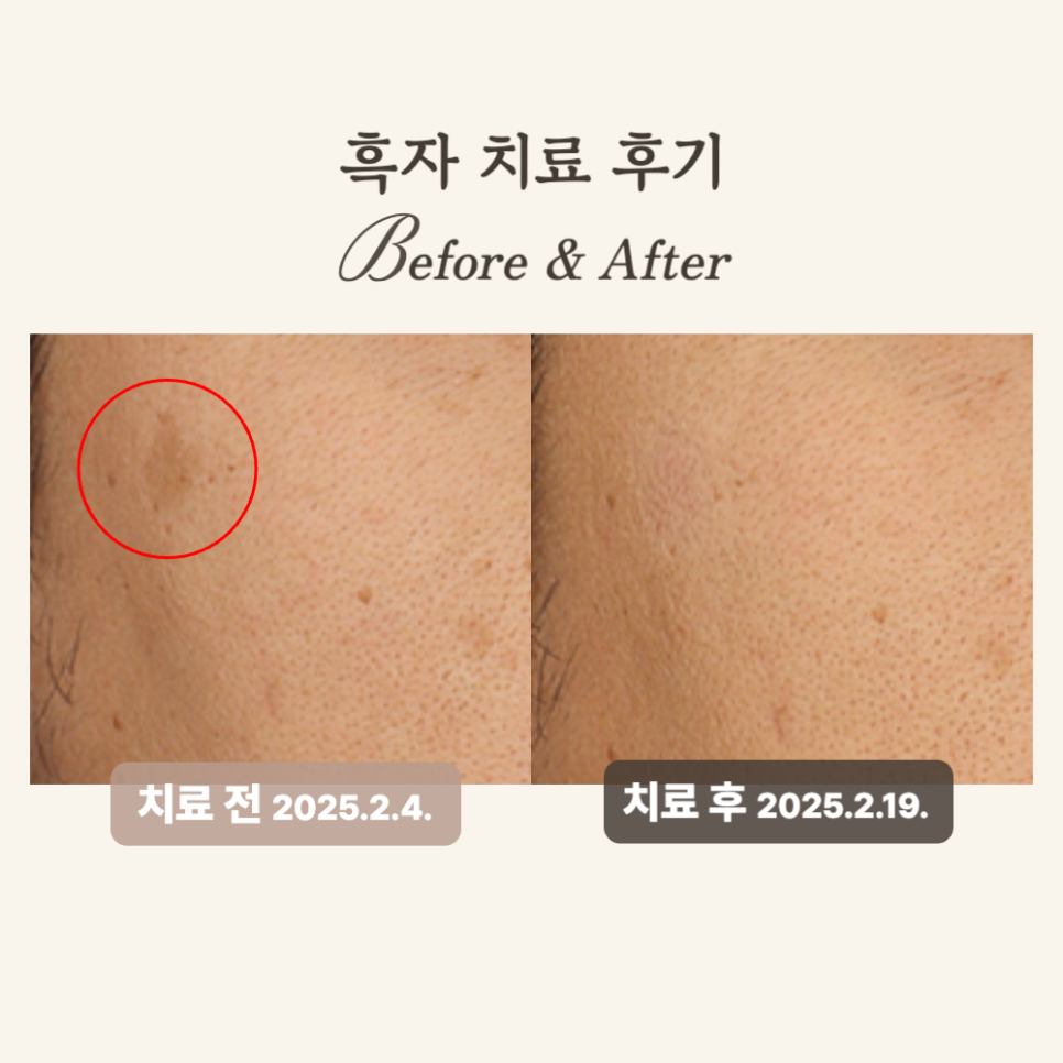 30대 피코토닝 시술 후기: 흑자 제거 후기