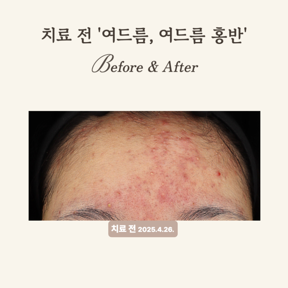 10대 이마 여드름, 브이빔 레이저와 PRP 치료 후기